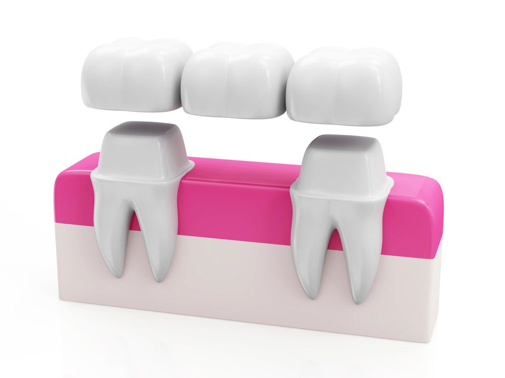 Digital graphic illustration of a dental bridge